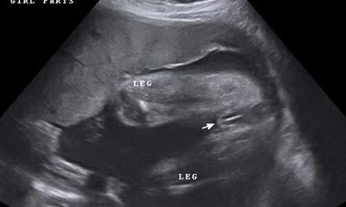 怀孕16周胎儿彩超图（怀孕16周胎儿彩超图）